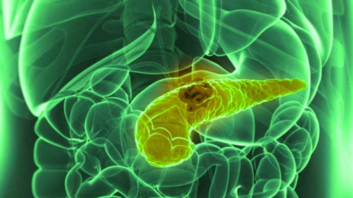 Tumore al Pancreas, arriva da Napoli lo studio condotto su nuovi farmaci