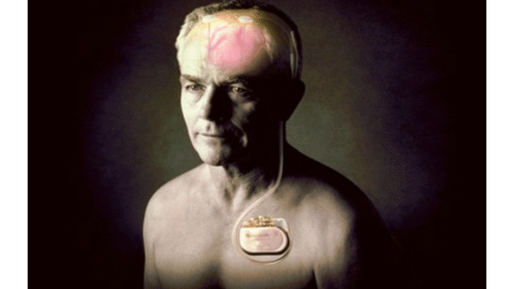 Con l’elettrostimolazione cerebrale si guarisce dal Parkinson?