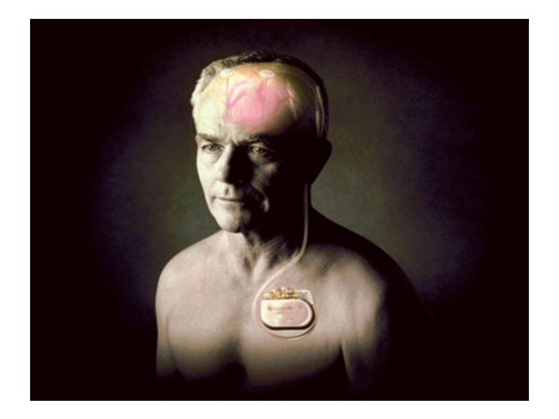 Con l’elettrostimolazione cerebrale si guarisce dal Parkinson?