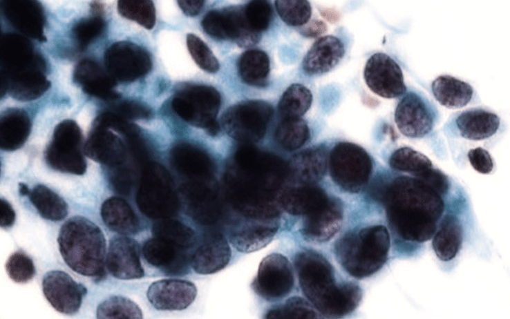 Nel vecchio continente la più alta incidenza di cancro