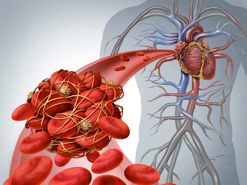 Ipercolesterolemia, app calcola il rischio cardiovascolare a dieci anni