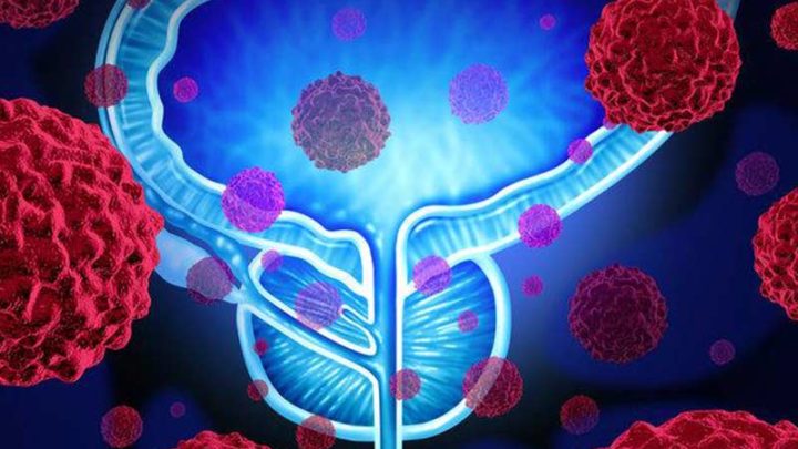Tumore prostatico, l’Aifa rimborsa terapia di ultima generazione