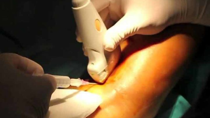 Ulcere, c’è la scleromousse ecoguidata