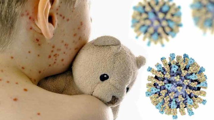 Morbillo, Ecdc segnala oltre 6.000 casi in Europa: Italia tra i Paesi più colpiti