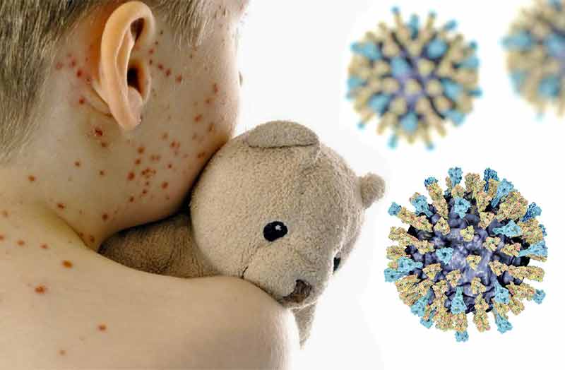 Morbillo, in aumento i casi in Europa