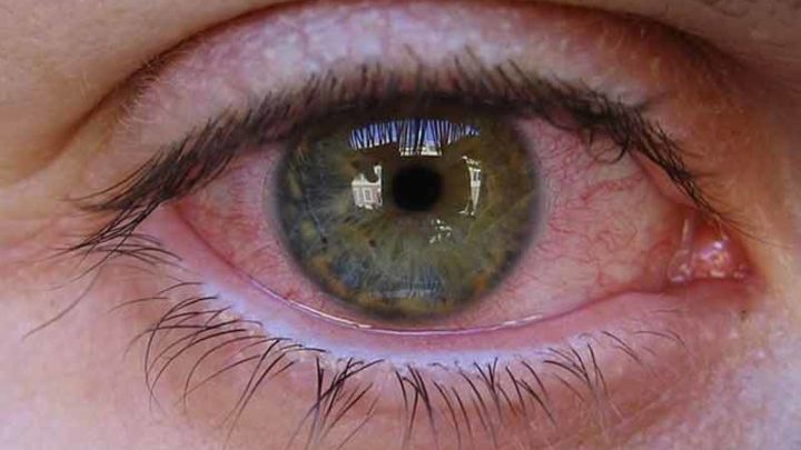 Piscina, attenzione alla salute degli occhi: da evitare le lenti a contatto