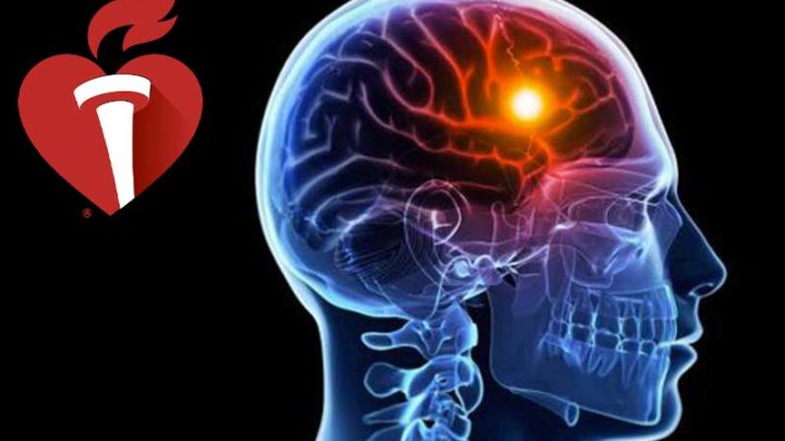 Ictus Ischemico, l’emicrania potrebbe esserne una spia