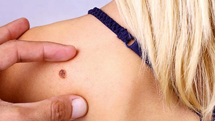 Melanoma, intelligenza artificiale e dermatologi a confronto nella diagnosi