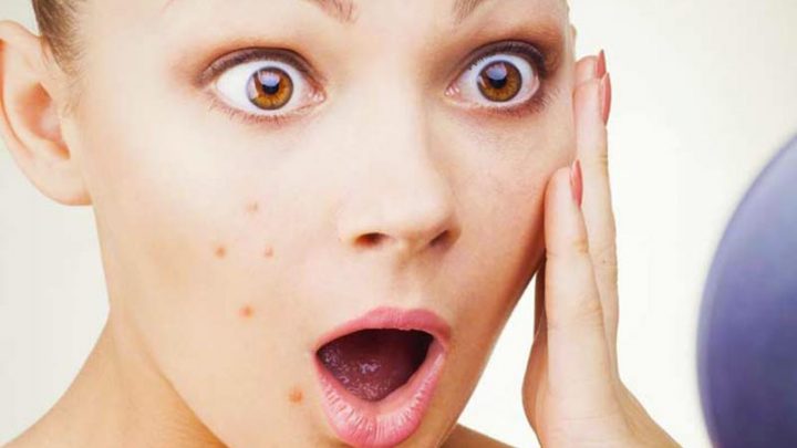 Acne vulgaris, il punto sulle terapie più efficaci
