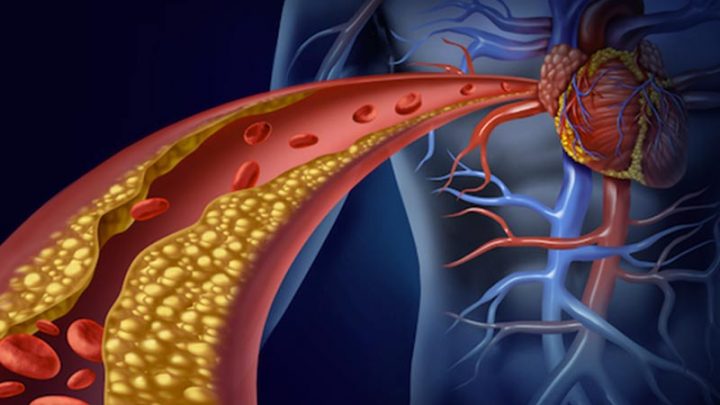 Colesterolo, nuove linee guida Usa sulla prevenzione cardiovascolare