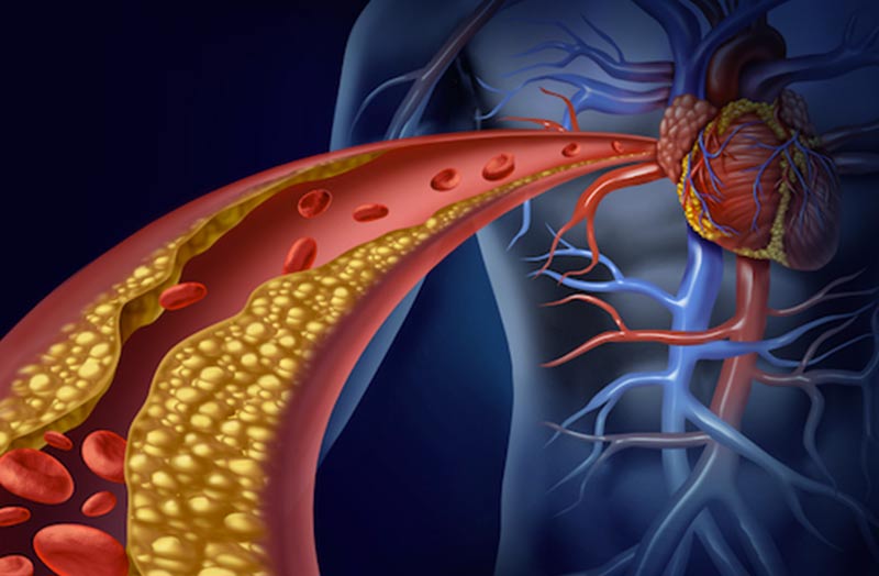 Colesterolo LDL, farmaco a mRNA dimezza livelli con due iniezioni l’anno