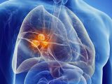 Cancro del polmone, l’importanza della diagnosi precoce