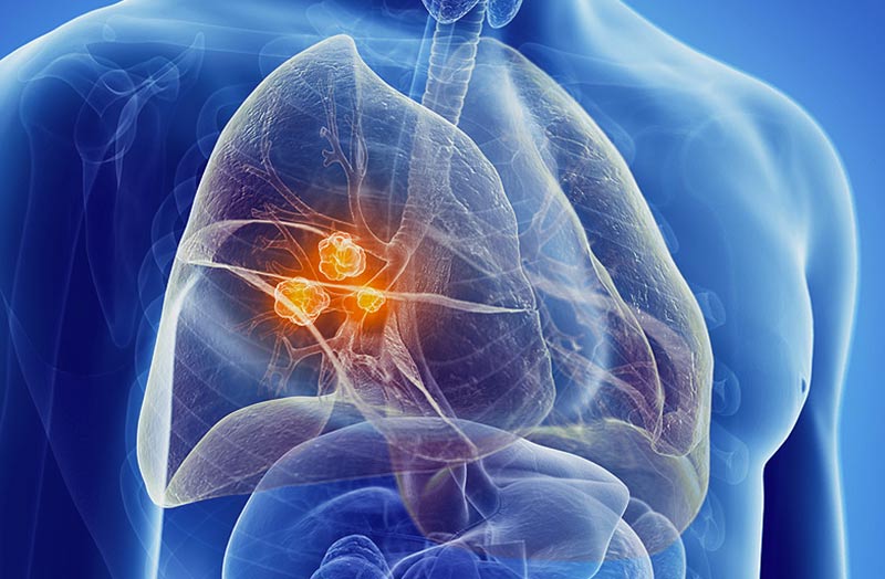 Cancro del polmone, l’importanza della diagnosi precoce