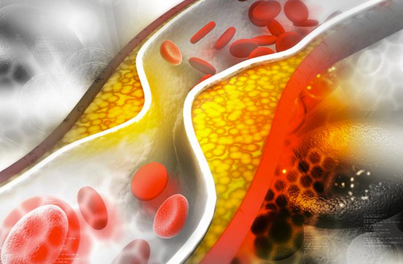 Colesterolo non-Hdl e rischio cardiovascolare