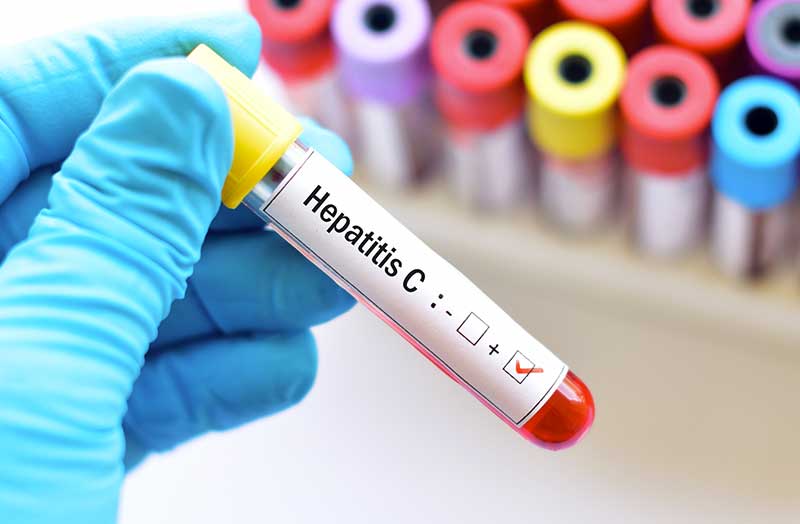 La cura per l’HCV e per la tossicodipendenza vanno di pari passo