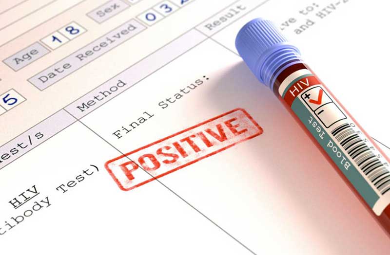 L’Aids non è debellata