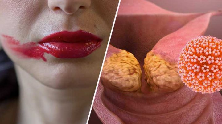 Il cancro della cervice uterina
