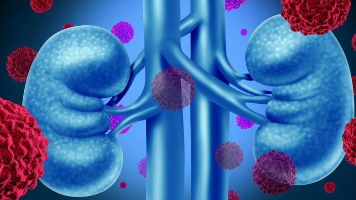 Nuovo trattamento per il carcinoma renale