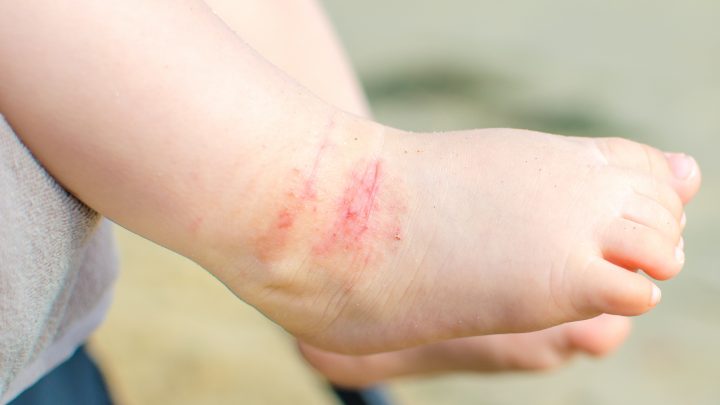 Dermatite atopica in età pediatrica
