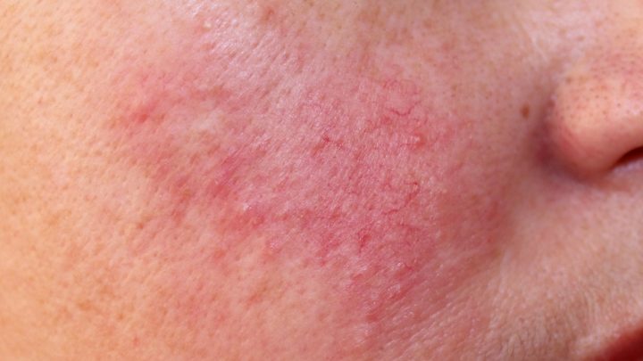 Rosacea, una malattia sottovalutata conoscerla significa curarla