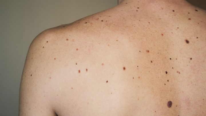 Malattie cutanee, esposizione ai raggi Uv provoca squilibrio microbico