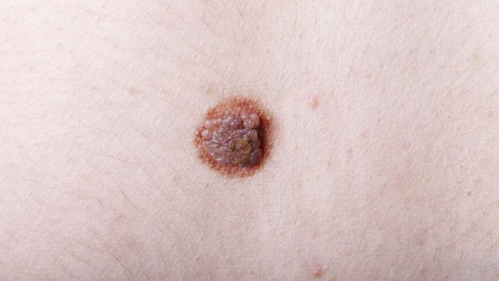 Studio: microaghi efficaci contro il melanoma della pelle