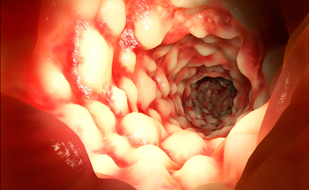 Malattia di Crohn, riflessi negativi sulla sessualità