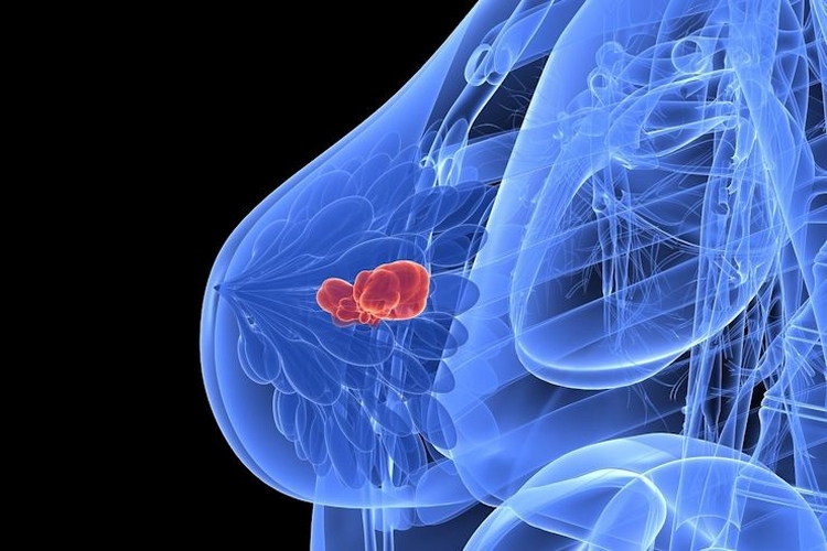Nuovi progressi contro le forme più aggressive di tumore al seno