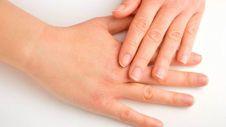 La pelle può essere spia di un’affezione da Covid
