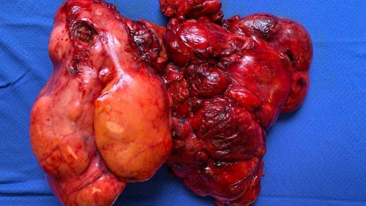 “Moscati” Avellino, asportato lipoma di 4 chili