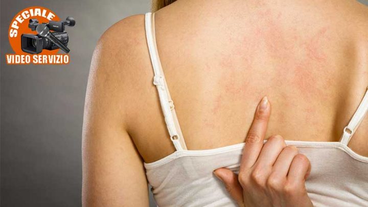 Prevenzione e cura dell’orticaria cronica