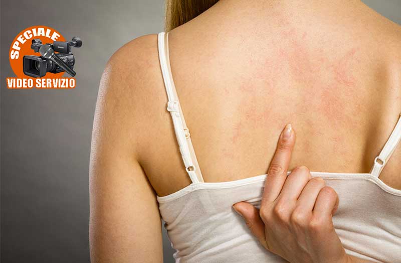 Prevenzione e cura dell’orticaria cronica