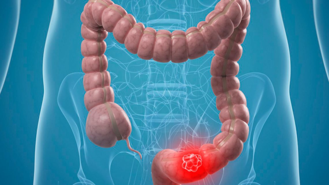 Usa, l’importanza della colonscopia dopo i 45 anni per la prevenzione del tumore del colon