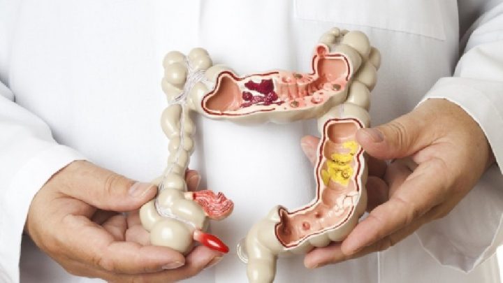 Malattia di Crohn e Colite Ulcerosa, pronta una nuova somministrazione sottocutanea