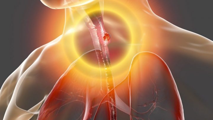 Combinazione di immunoterapia e chemioterapia aumenta le possibilità di sopravvivenza di chi è colpito da tumore all’esofago