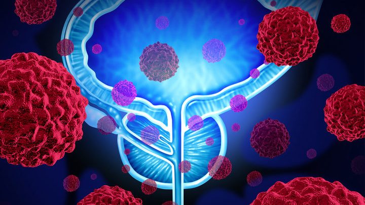 Cancro della prostata, a Napoli nuove metodiche diagnostiche