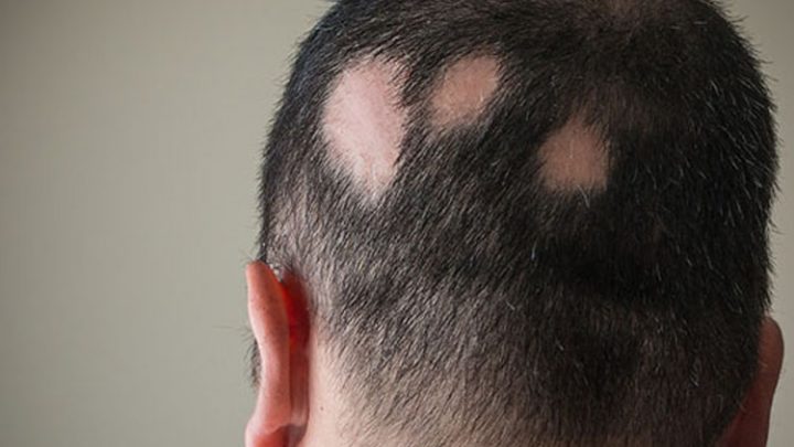 Nuove cure per l’alopecia al congresso SIDeMaST