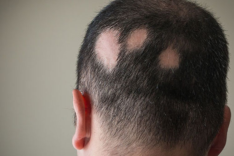 Nuove cure per l’alopecia al congresso SIDeMaST