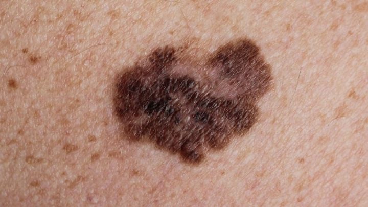 Melanoma, con l’immunoterapia aumentano le guarigioni