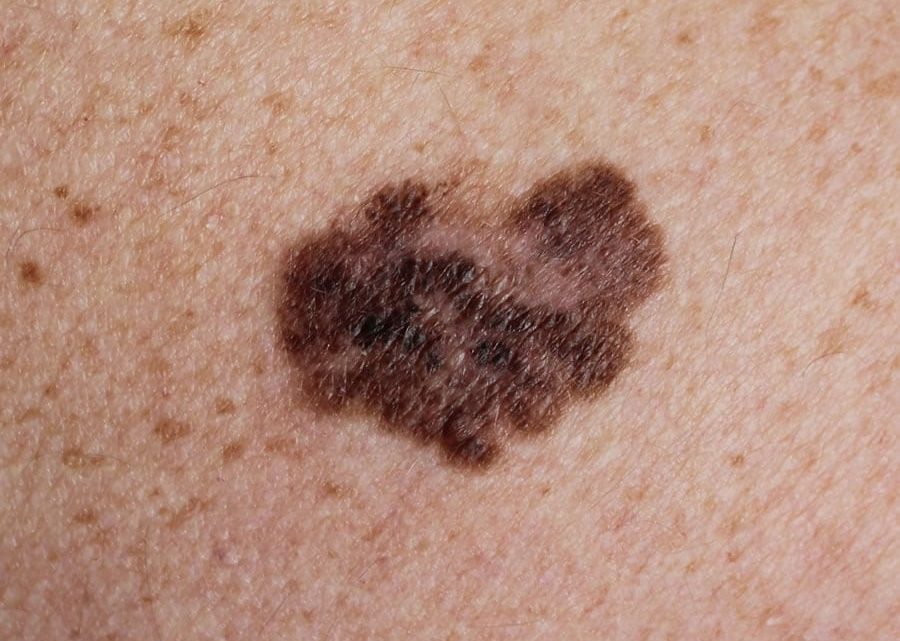 Melanoma, con l’immunoterapia aumentano le guarigioni