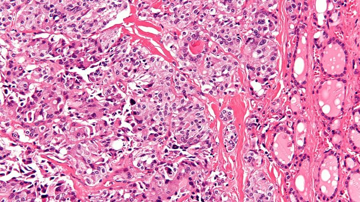 Carcinoma midollare tiroideo, diagnosi e follow-up: procalcitonina marcatore alternativo a calcitonina