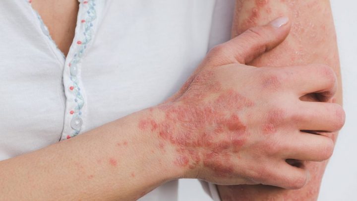 Psoriasi, a Napoli il punto sullo stato dell’arte