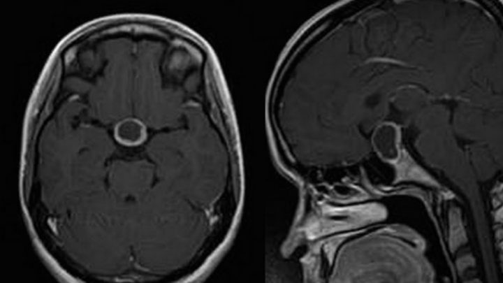 Microadenomi ipofisari non secernenti, da estendere l’intervallo del controllo RM