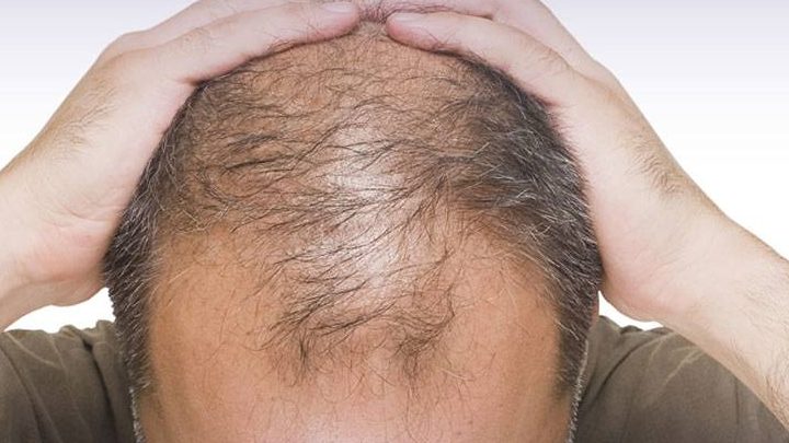Calvizie, dal Giappone lo studio per difendersi