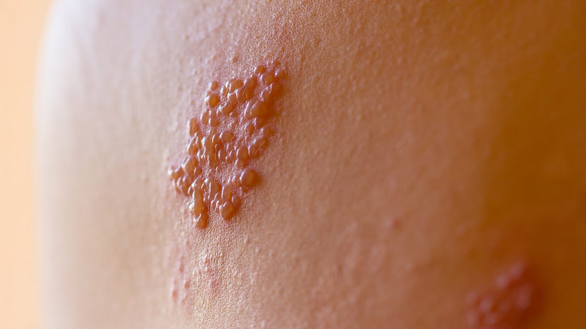 Asl Avellino, Open day dedicato alla prevenzione dell’infezione da Herpes Zoster