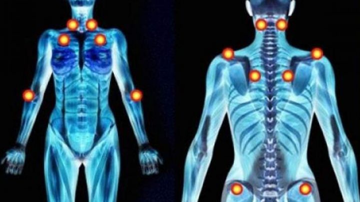 Napoli, appuntamento con la fibromialgia: malattia invalidante e semisconosciuta