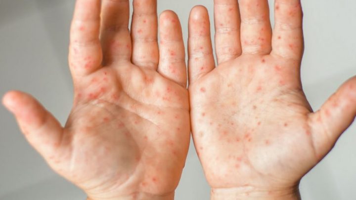 Pediatri, dopo 3 anni di stop tornano ad aumentare i casi di Scarlattina
