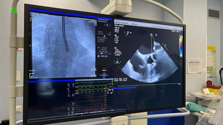 Chiusura percutanea dell’auricola sinistra, la Cardiologia dell’ospedale di Boscotrecase apre lo sguardo al futuro