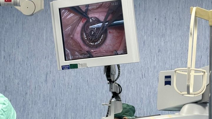 Ospedale Boscotrecase, col trapianto di cornee 25enne ritrova la vista