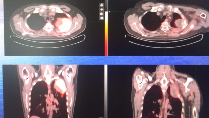Convegno internazionale di radioterapia, il Reparto del “Ruggi” si distingue per nuova metodica